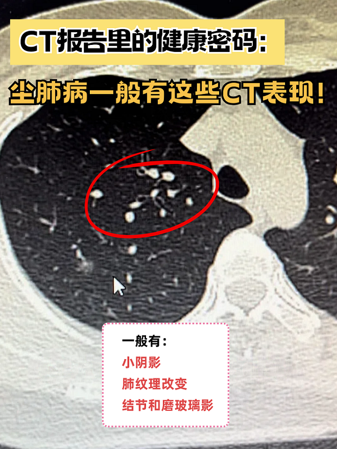 ct报告里的健康密码:尘肺病一般有这些ct表现!