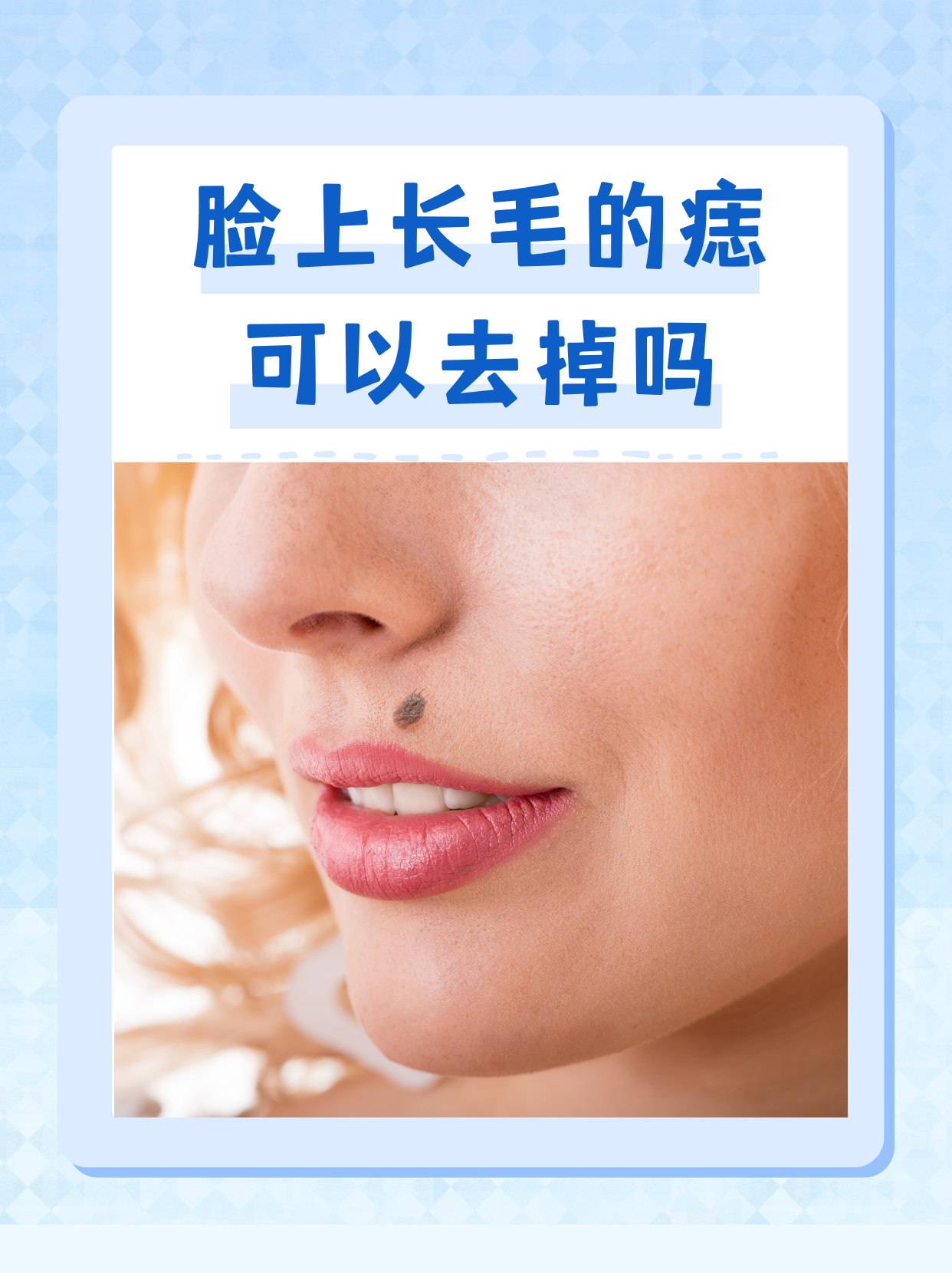 脸上长毛的痣可以去掉吗