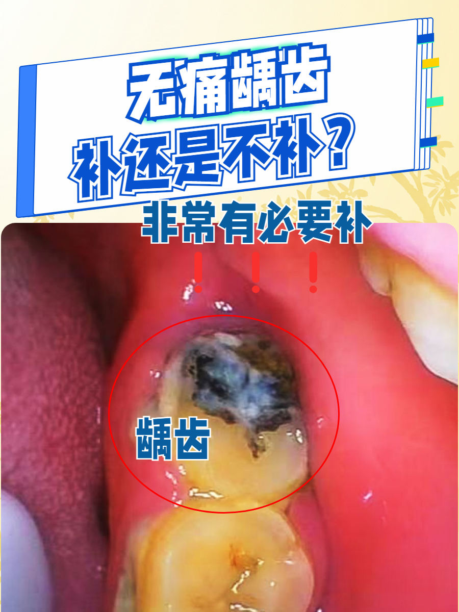 为什么会蛀牙的原因有哪些百科在线 为什么会蛀牙的原因有哪些百科在线