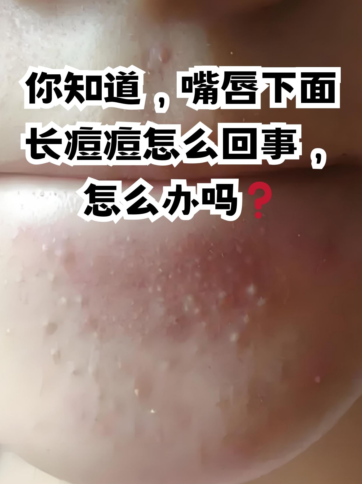 为什么嘴巴周围老是反复长痘痘,吃什么中成药?为什么在线 为什么嘴巴周围老是反复长痘痘,吃什么中成药?为什么在线