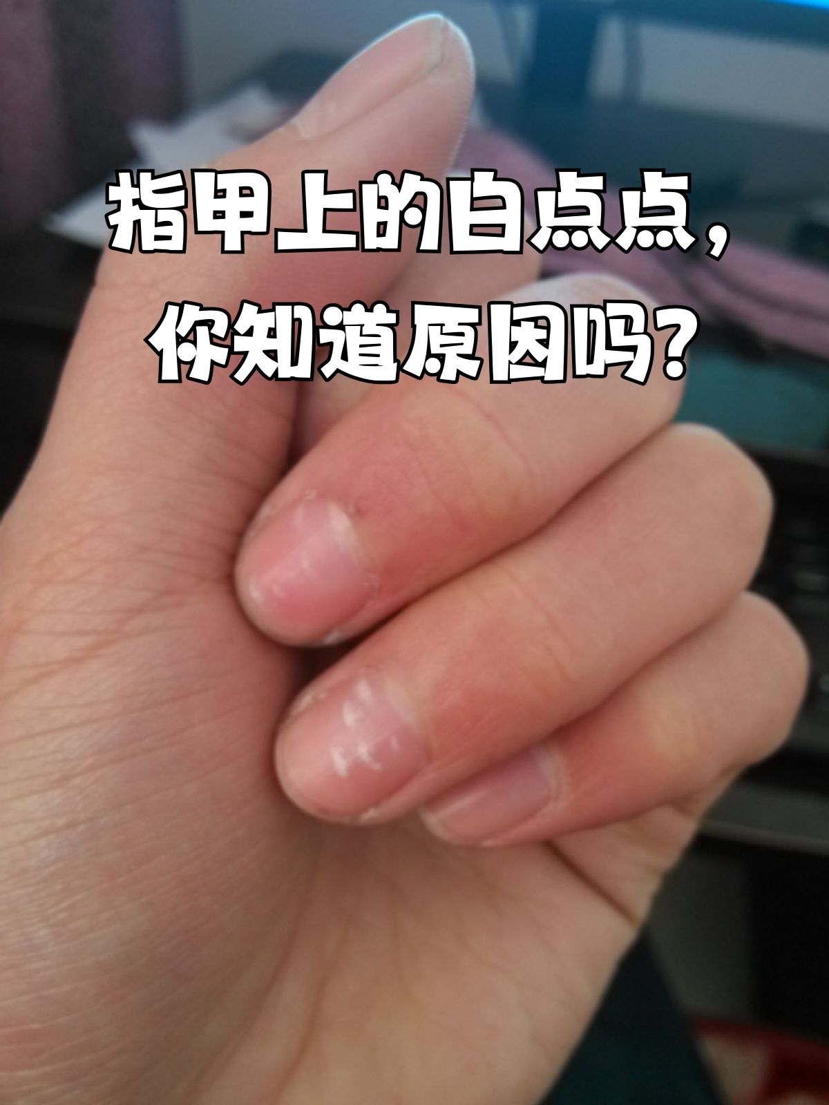 指甲上的白点点,你知道原因吗?