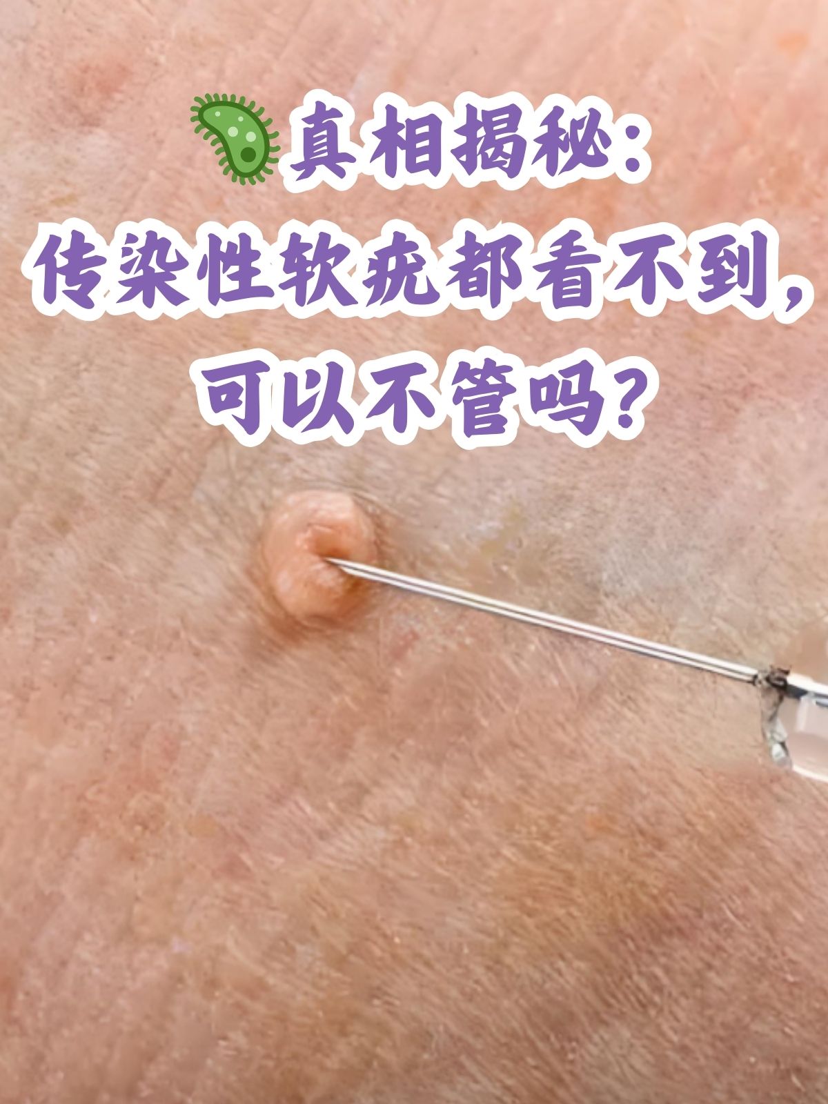 传染性软疣是一种由传染性软疣病毒引起的皮肤感染