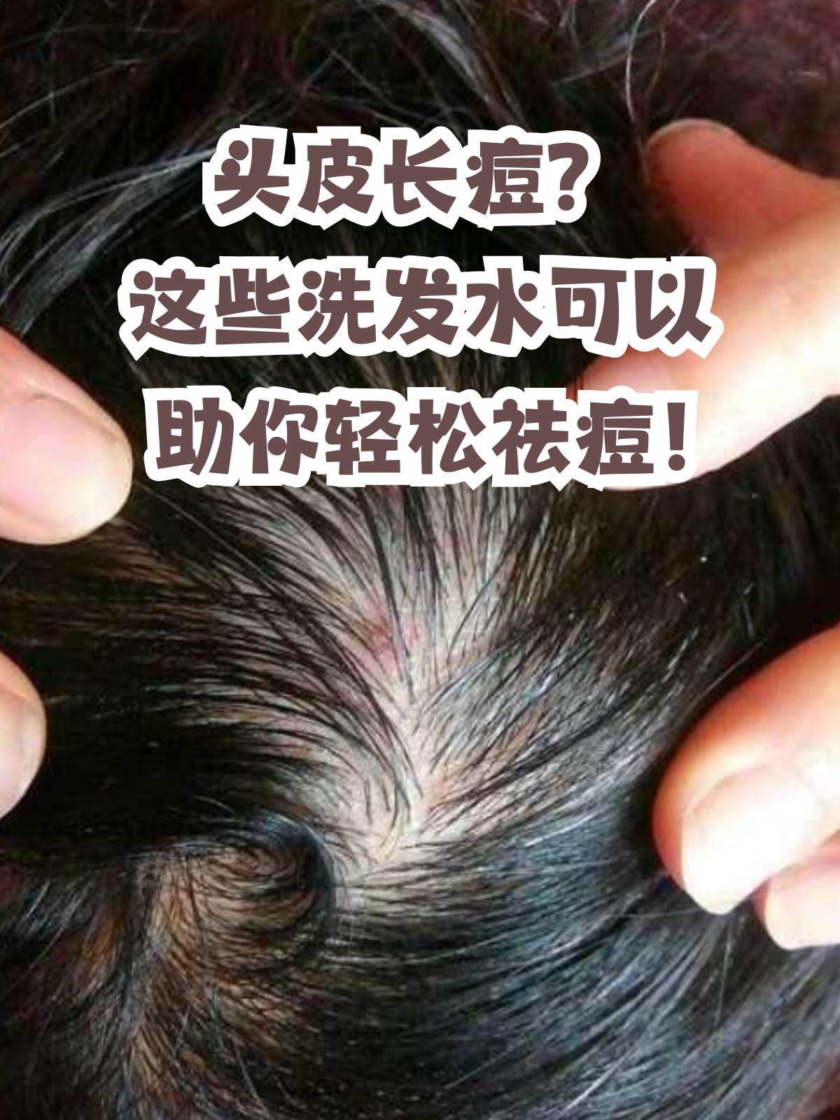 头皮痒能挂皮肤科么吗女（头皮痒能挂皮肤科么吗女性）《头皮痒可以去看皮肤科吗》