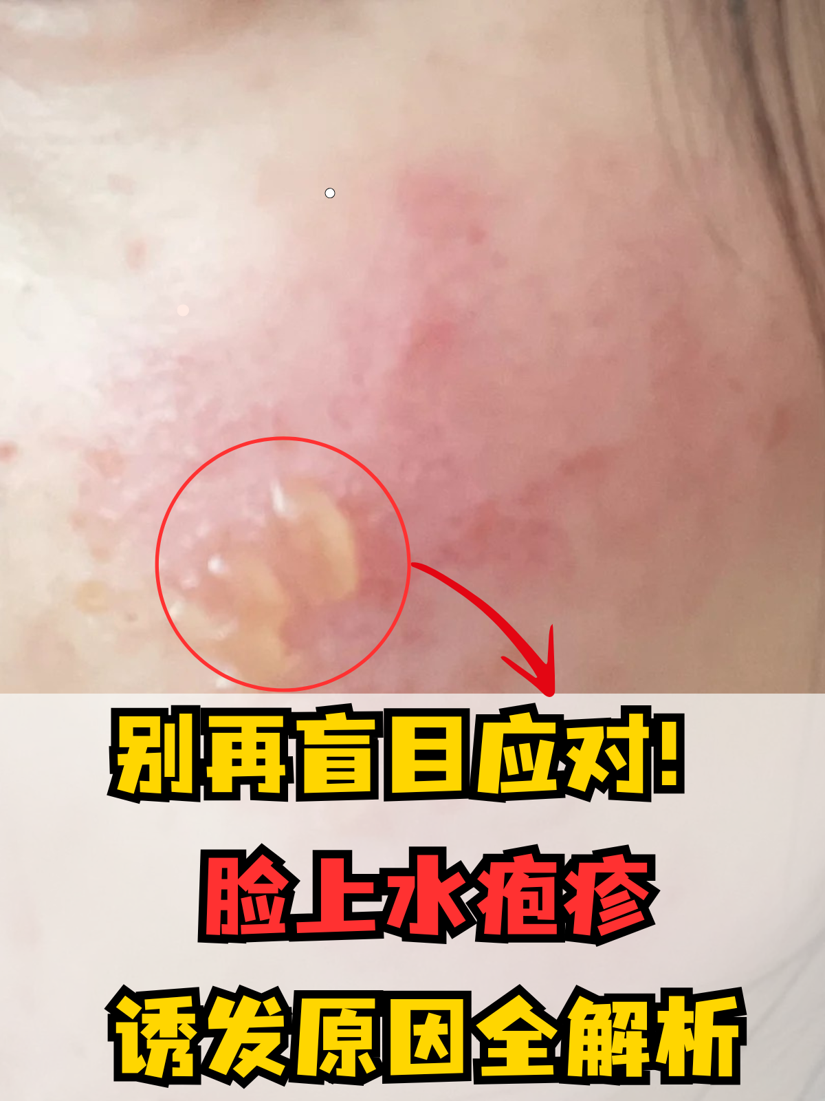 单纯疱疹脸上起疱疹是什么原因造成的长疱疹面部针尖大的小疱疹痒是