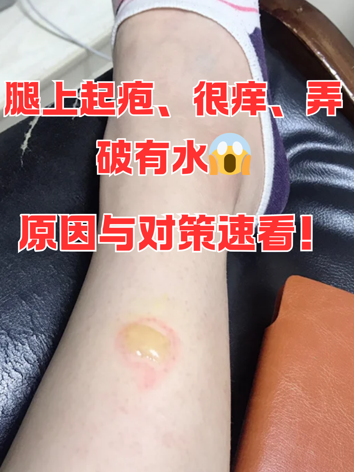 腿上起疱,很痒,弄破有水原因与对策速看!