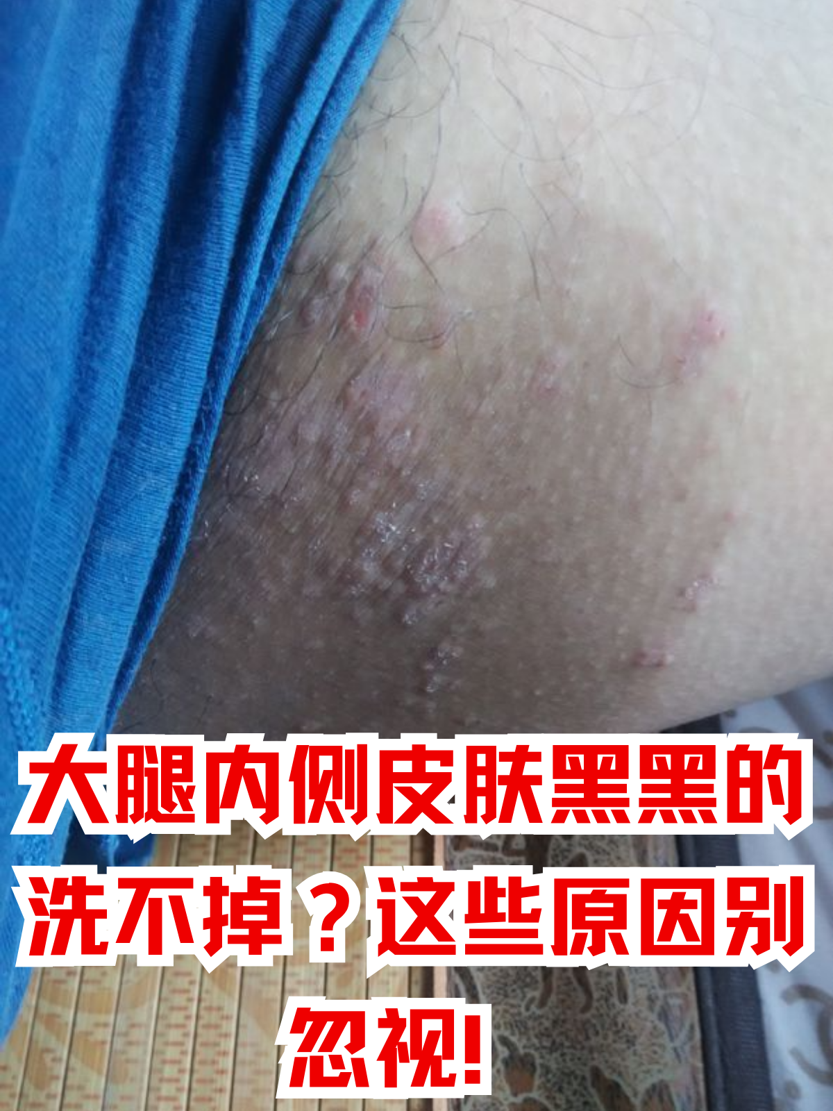 怎么判断是不是黑棘皮大腿内侧皮肤褶皱图片大腿内侧皮肤黑黑的洗不掉