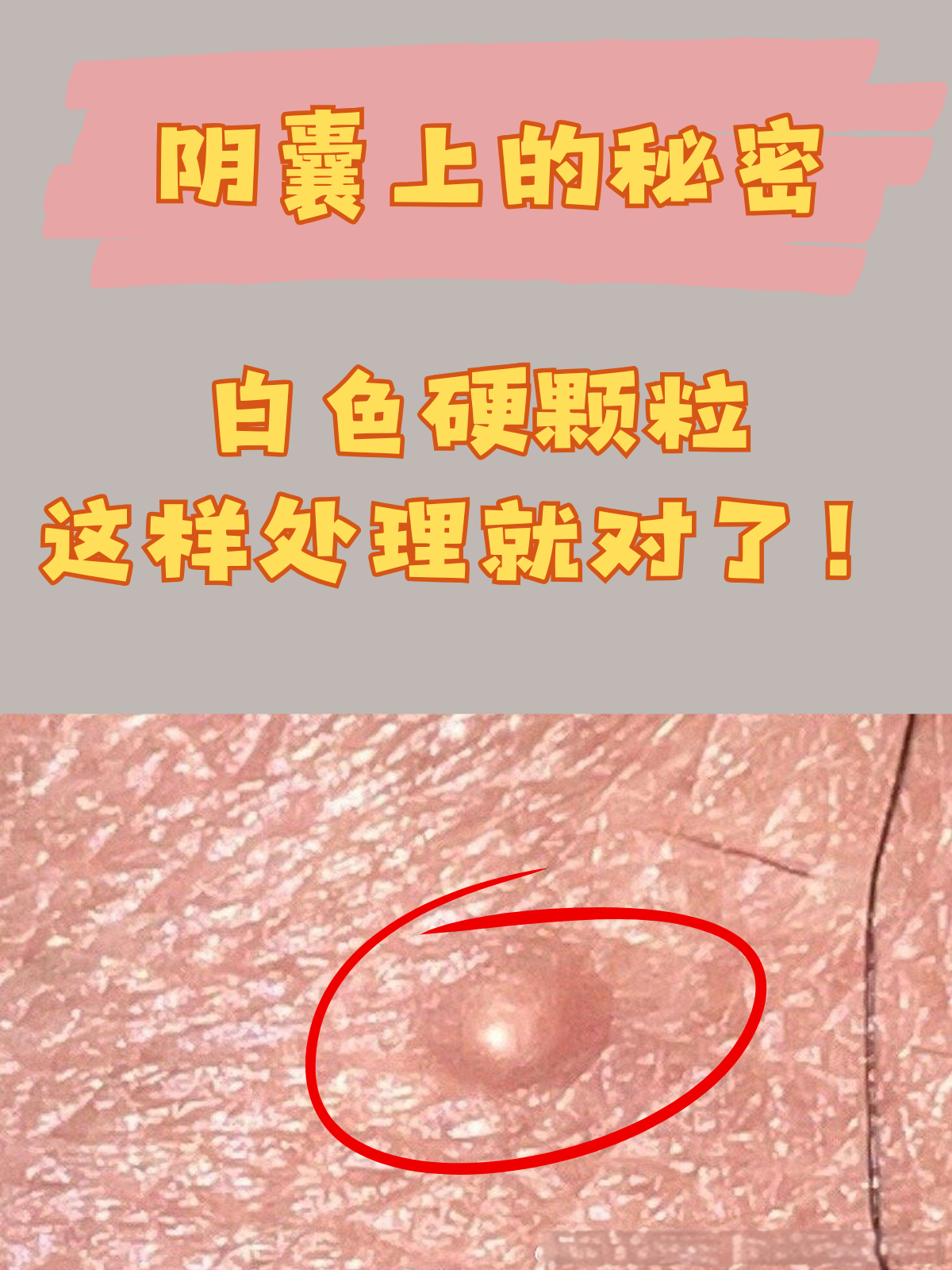 阴囊长了个白色硬颗粒,这究竟是怎么回事?又该如何应对呢?