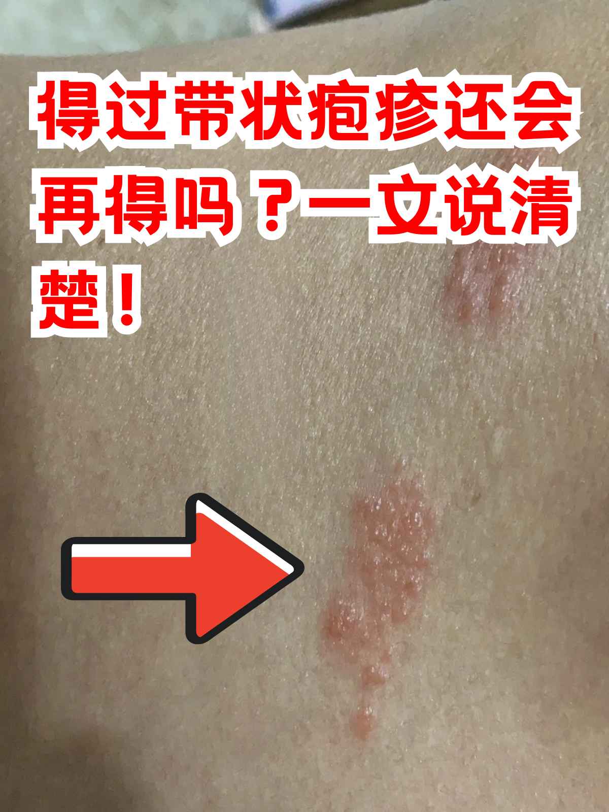 带状疱疹作为一种由水痘