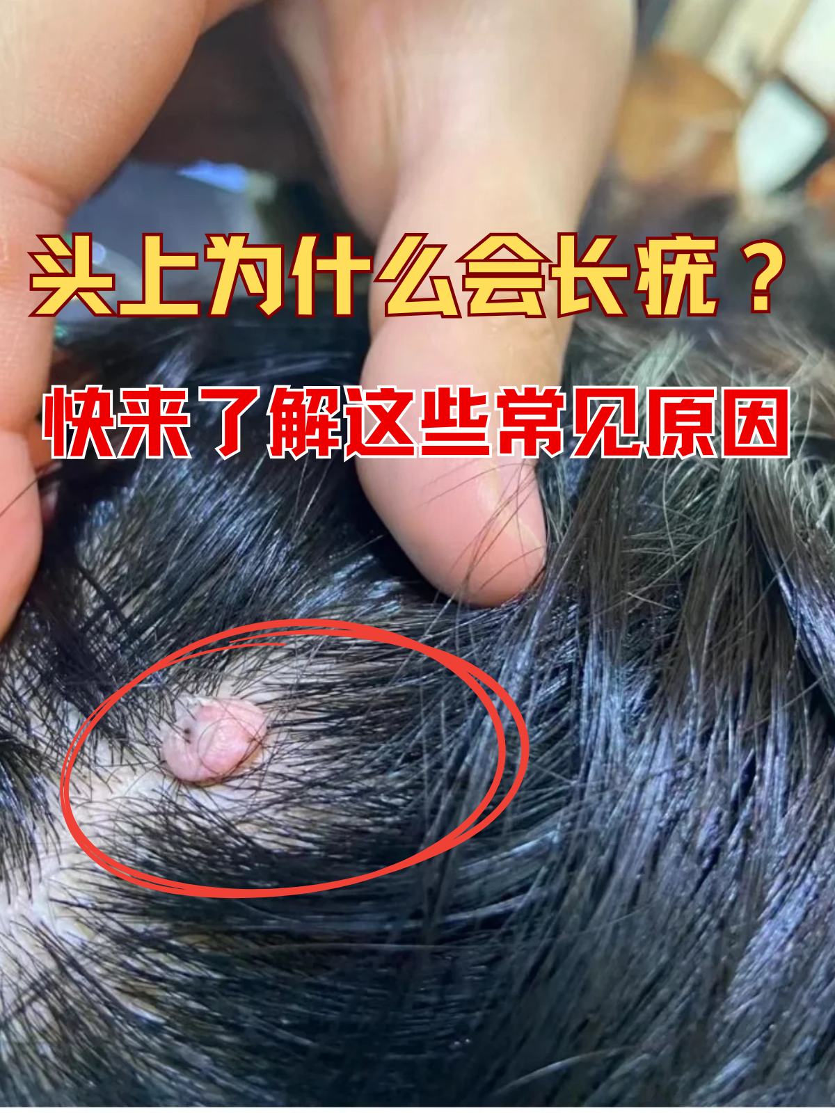 快来了解这些常见原因 头上长疣,这一看似不起眼的皮肤问题,实则隐藏