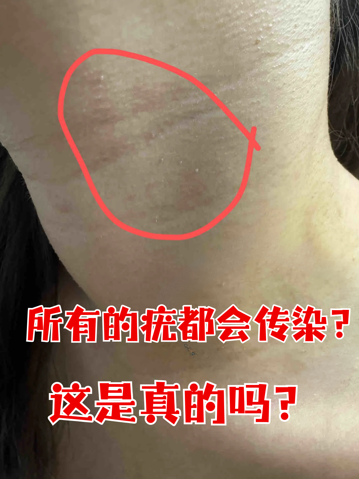 疣通常表现为皮肤上小的,粗糙的增生,有时也可能平滑或稍微隆起