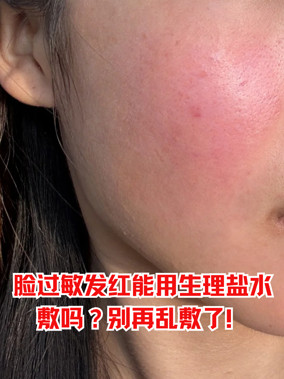 最近不少敏感肌人群在面对脸部过敏发红时,都会纠结一个问题:"用生理