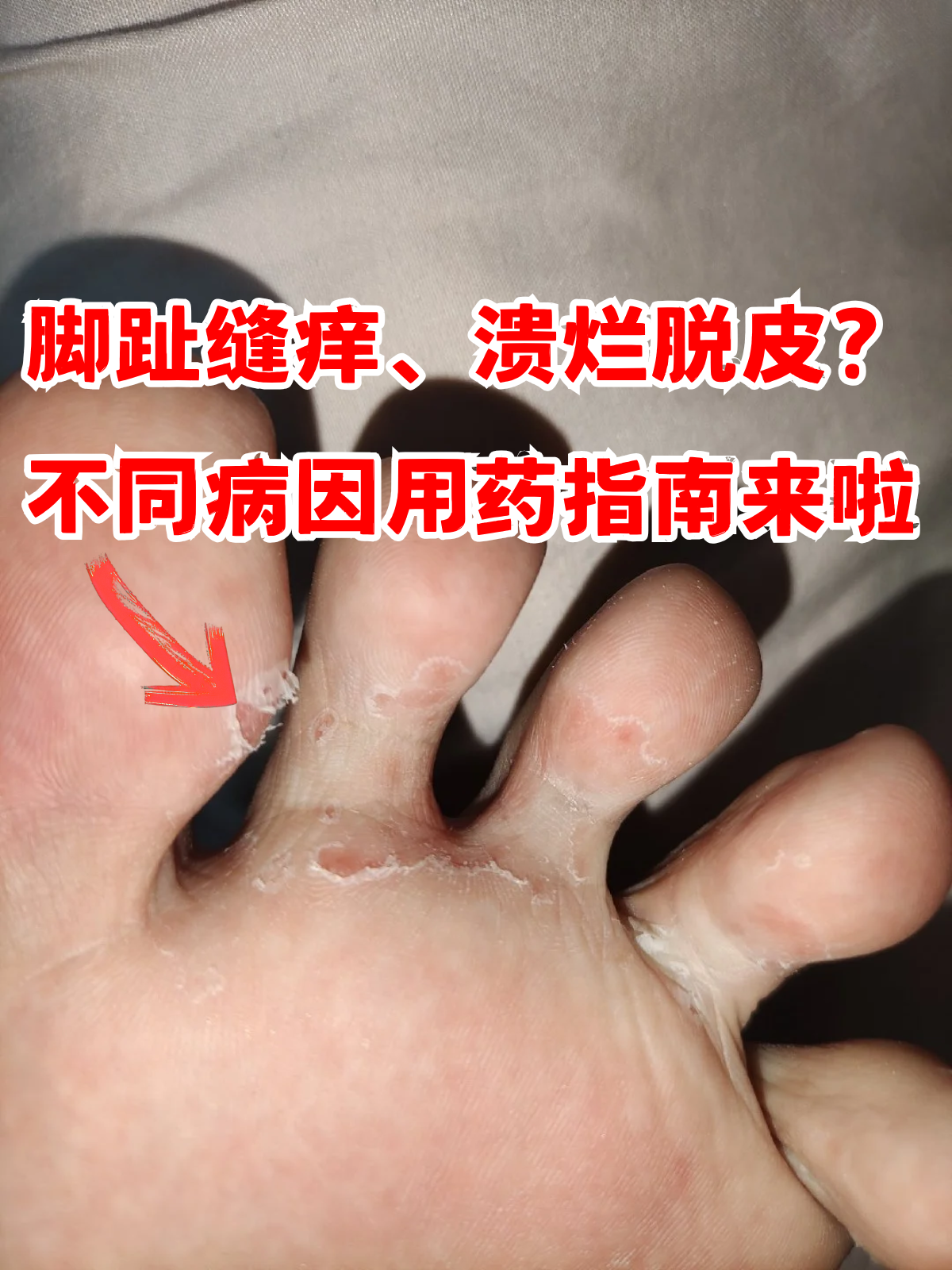 脚趾缝痒,溃烂脱皮?