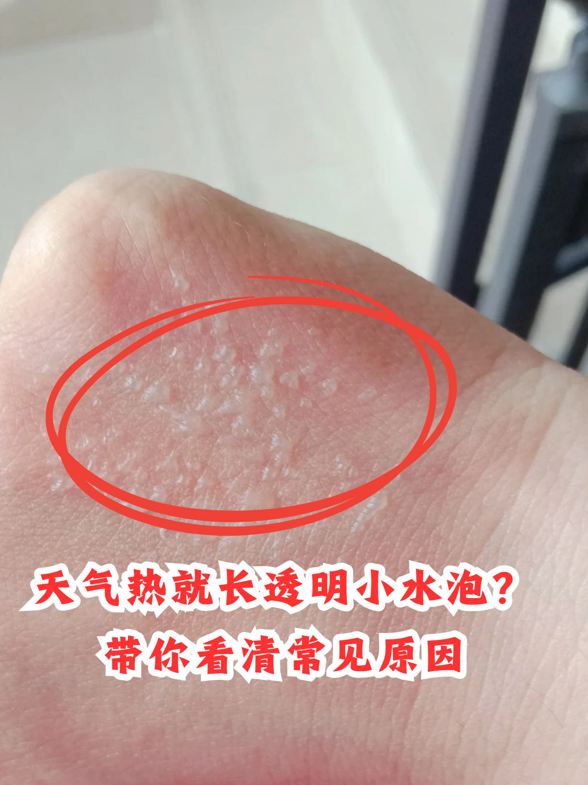 天气一热手上就起小水泡