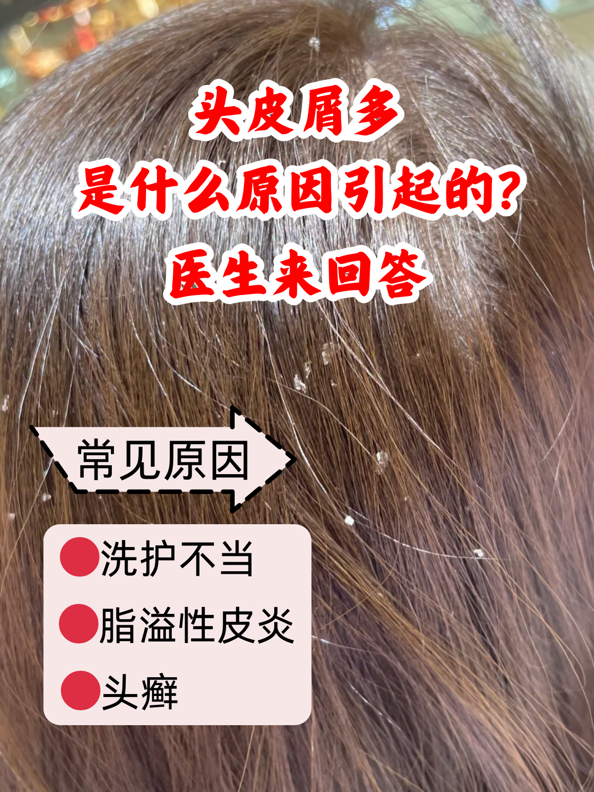 为什么头皮多 为什么头皮多