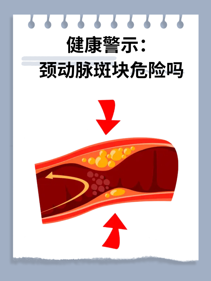 左侧颈动脉斑块形成图片