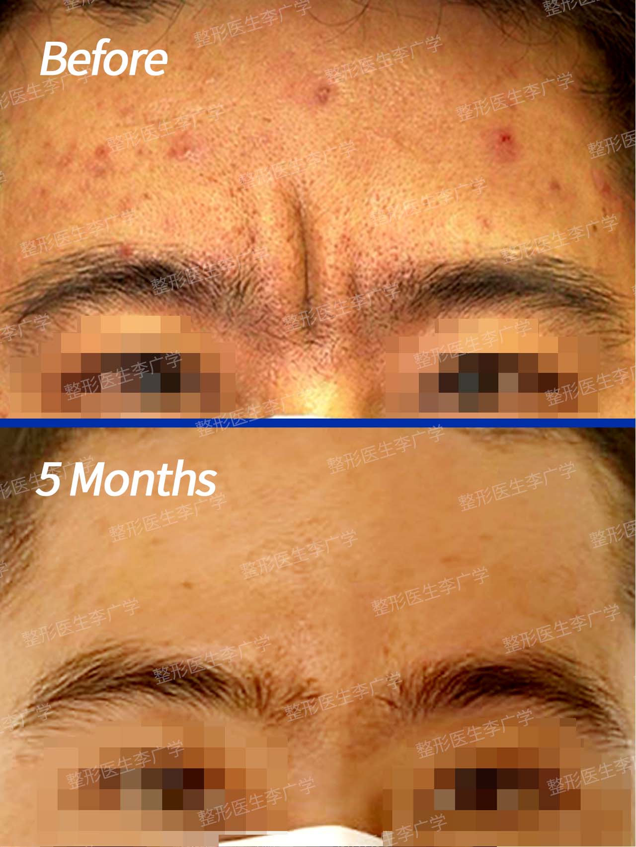 5种常见的眉字纹,川字纹,你属于哪一种?