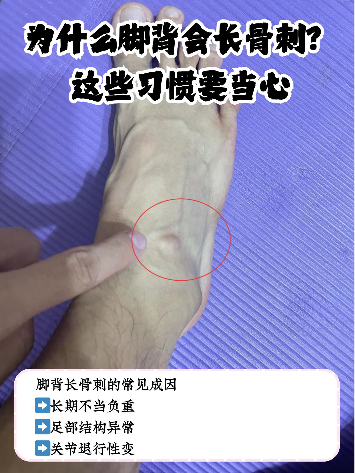 脚背长骨刺多由慢性损伤,关节退变或力学异常引起,是