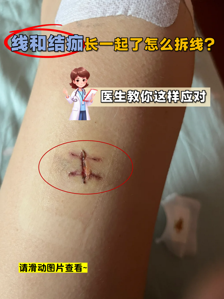线和结痂长一起了怎么拆线?