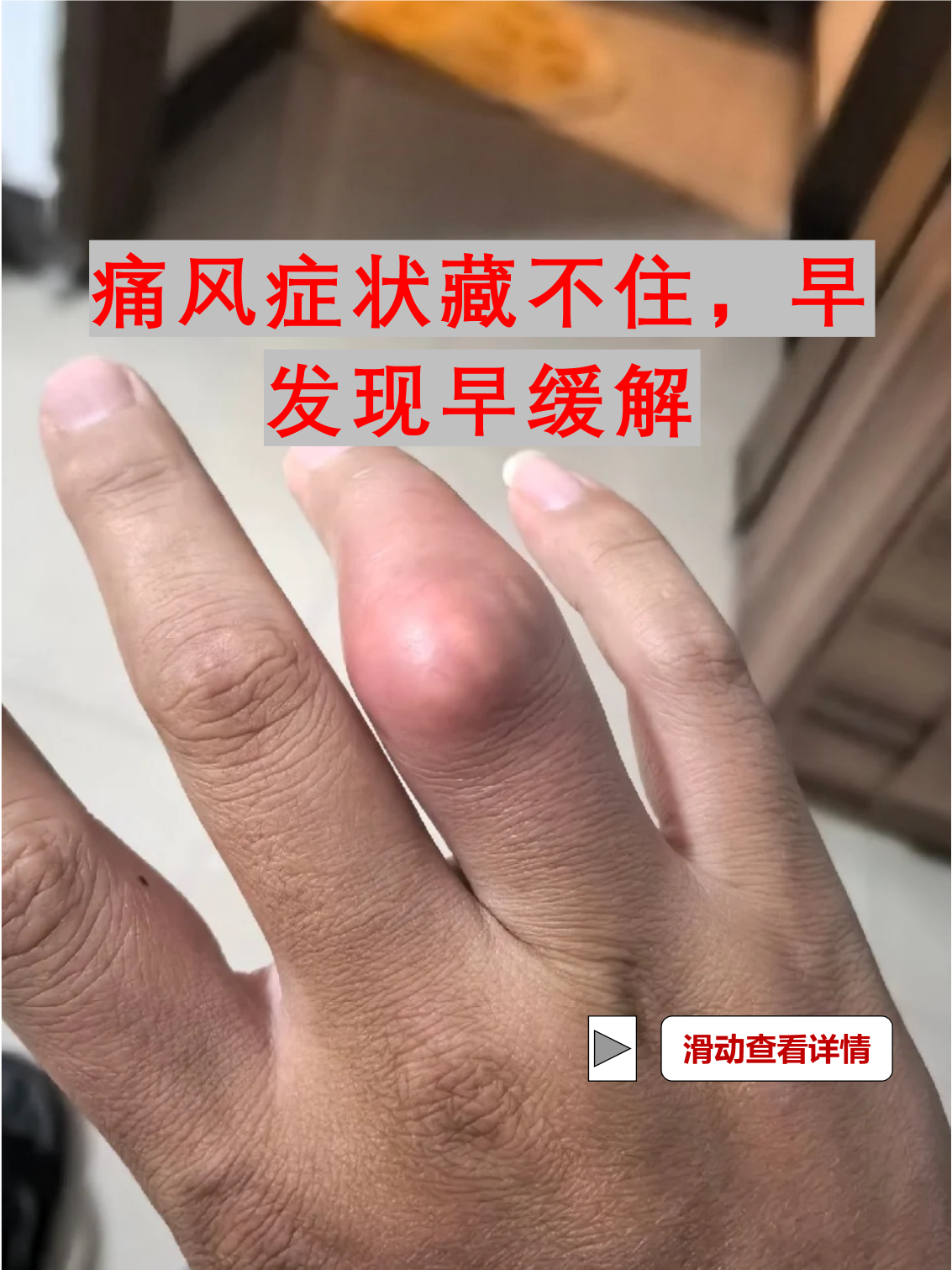 痛风症状藏不住,早发现早缓解