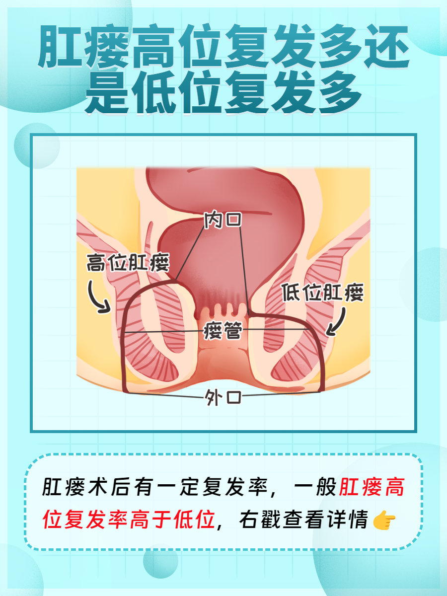 肛瘘瘘管位置图片