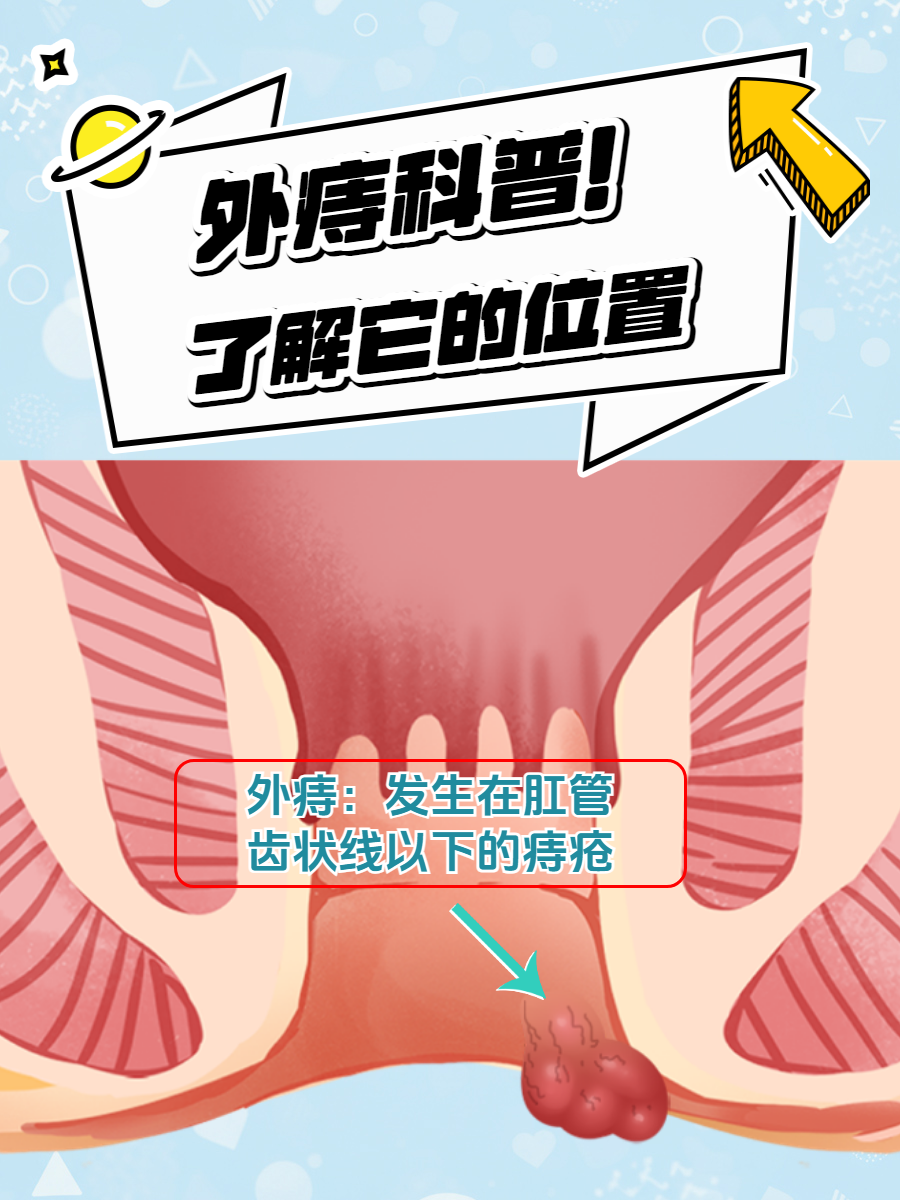 外痔,作为痔疮的一种类型,是指发生在肛管齿状线以下的