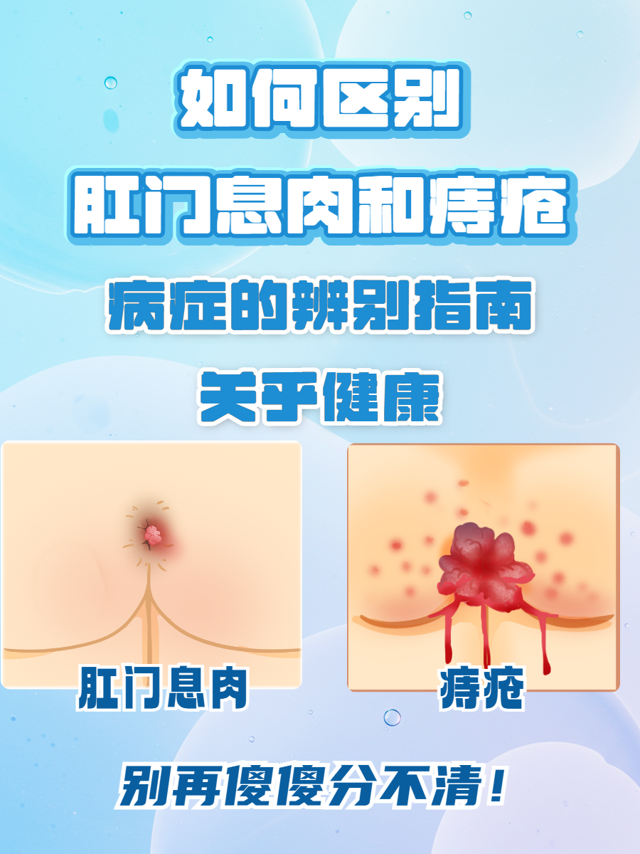 病症的辨别指南关乎健康! 肛门长 "小肉球" 分不清是息肉还是痔疮?