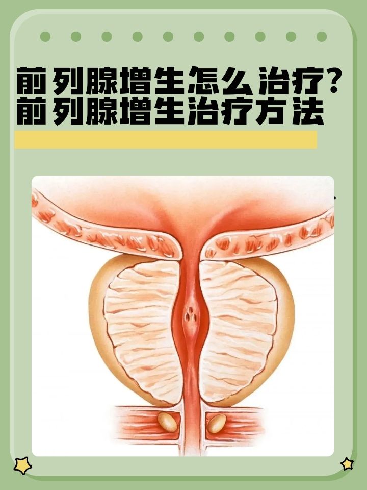 前列腺增生治疗