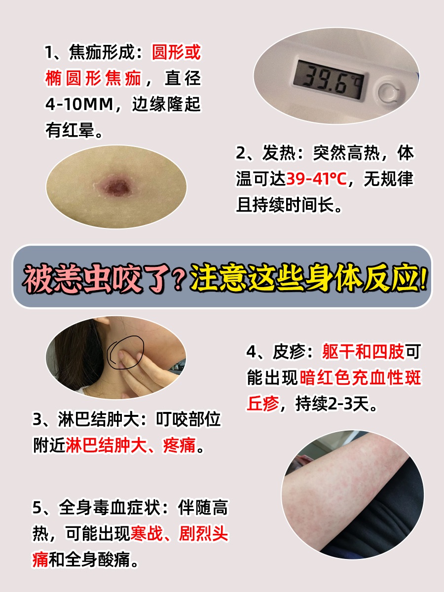 恙虫也被称为恙螨,是一种能够传播病毒的昆虫
