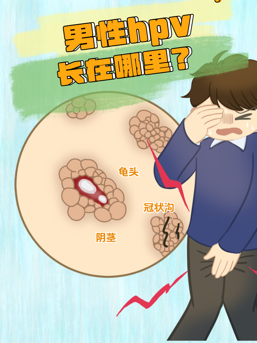男性hpv指的是男性感染了人乳头瘤病毒,感染可