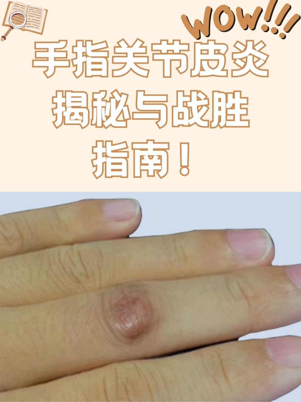 9498手指关节皮炎主要表现为关节处的皮肤红肿,瘙痒,脱屑和