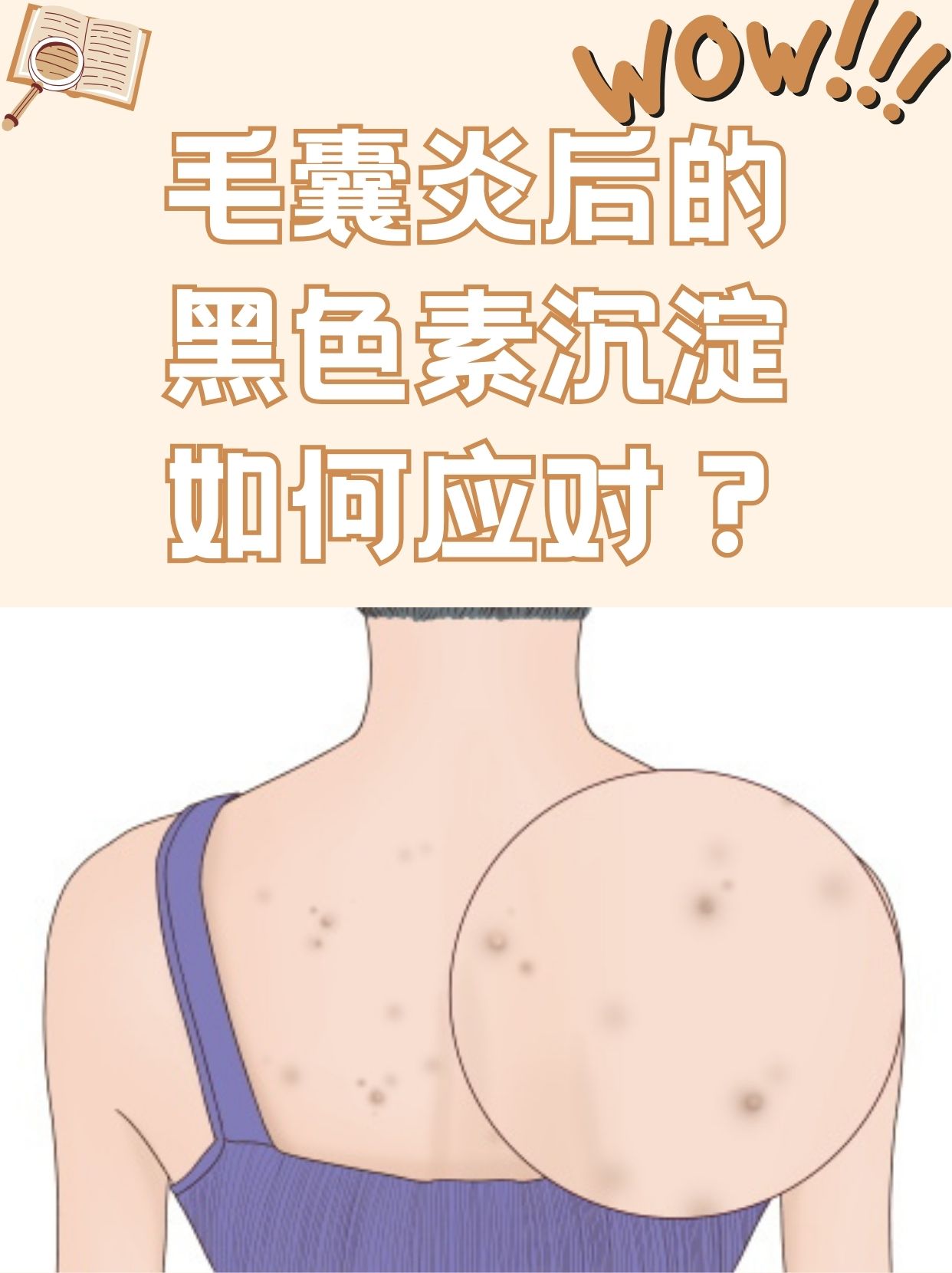毛囊炎后的黑色素沉淀,如何应对?