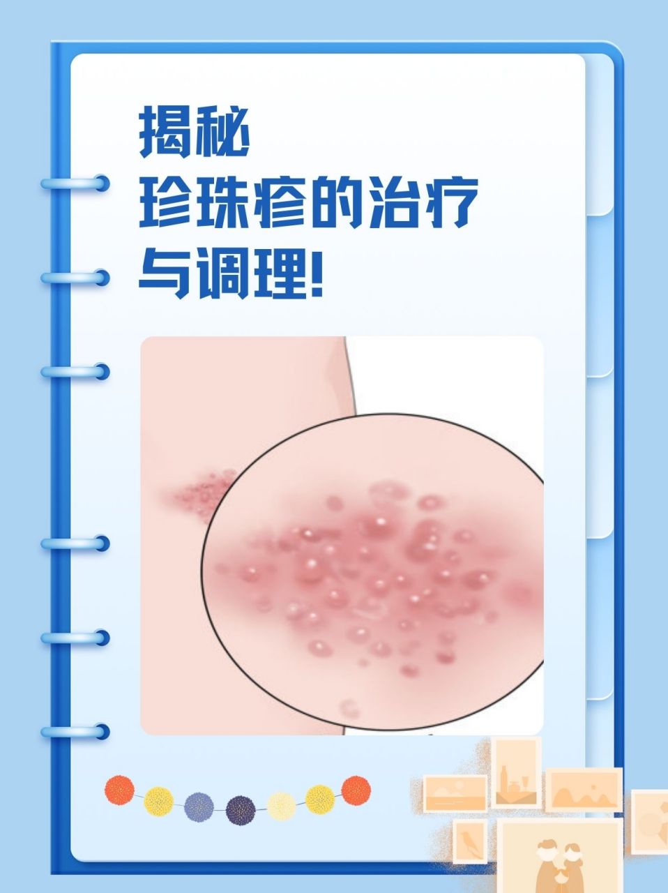 98697115珍珠疹一般指珍珠样阴茎丘疹,主要表现为男性龟头