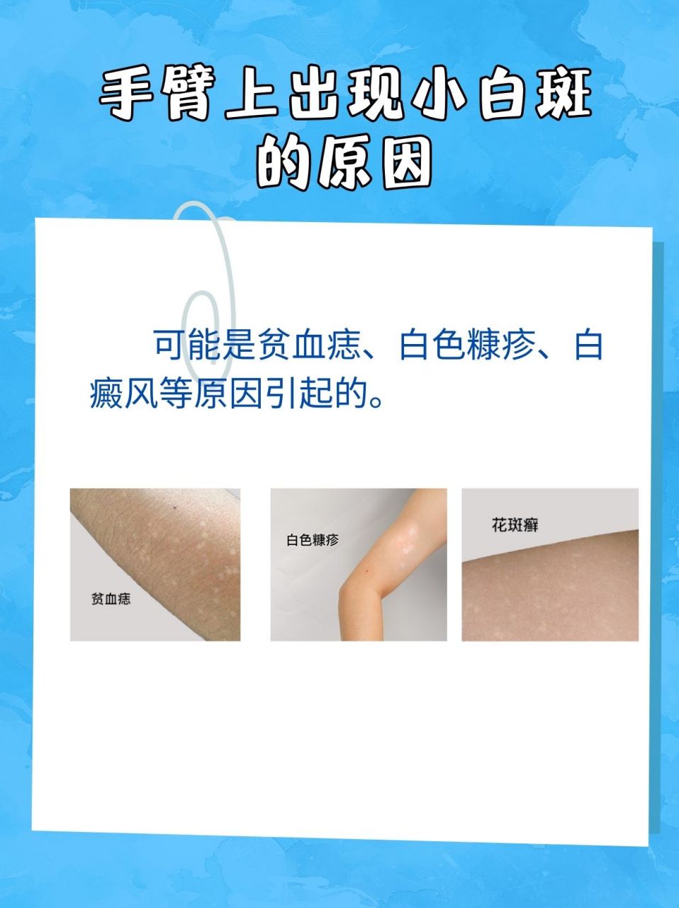 986903手臂上出现小白斑可能是贫血痣,白色糠疹,斑驳病
