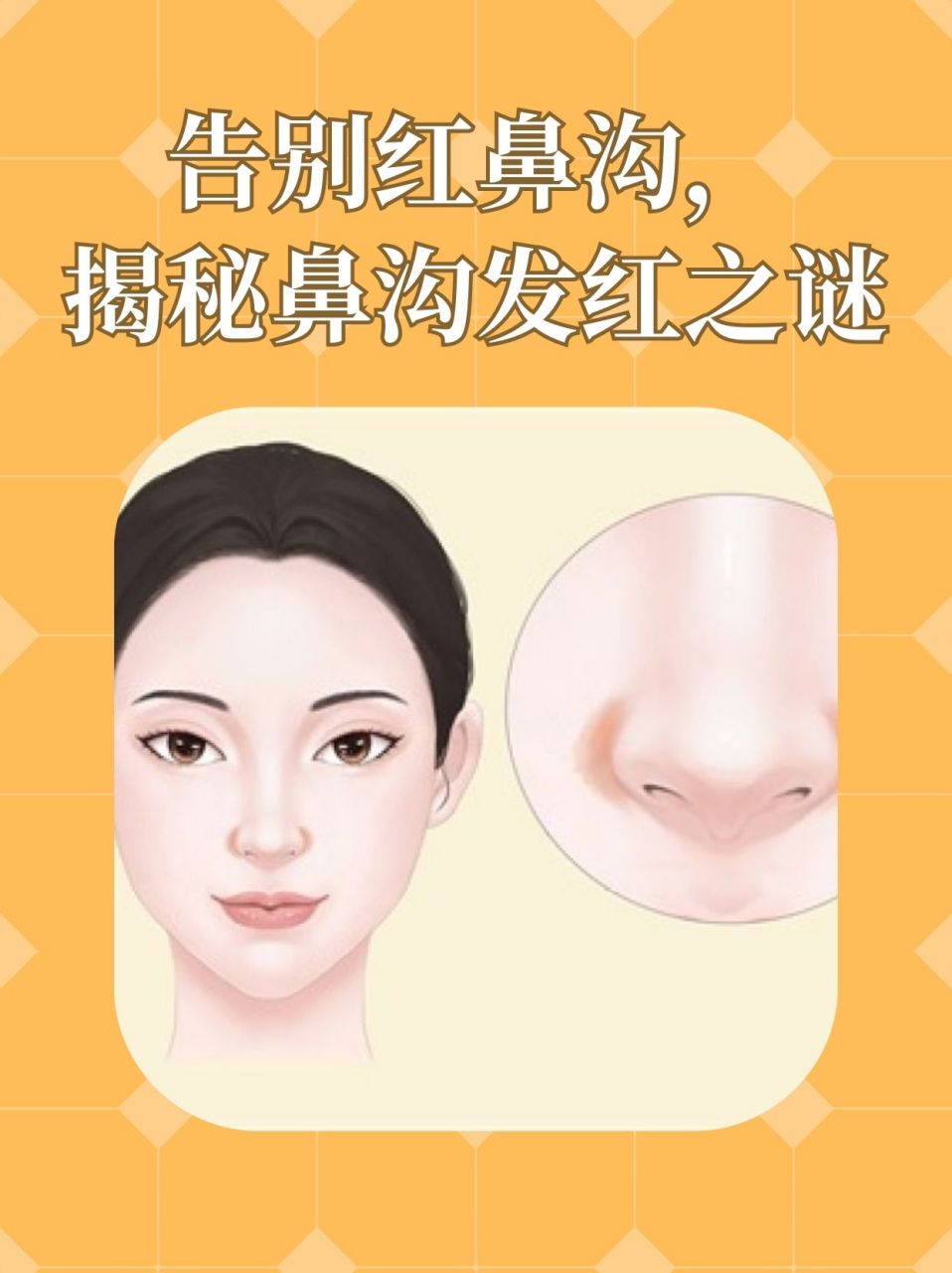 之谜   98697115鼻子两侧鼻沟发红,有可能是以下原因引起的