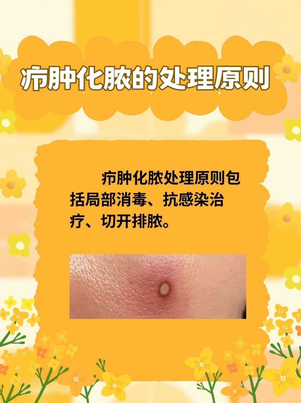 🔍疖肿化脓自己处理的方法主要是局部消毒,抗感染治疗,清淡饮食.