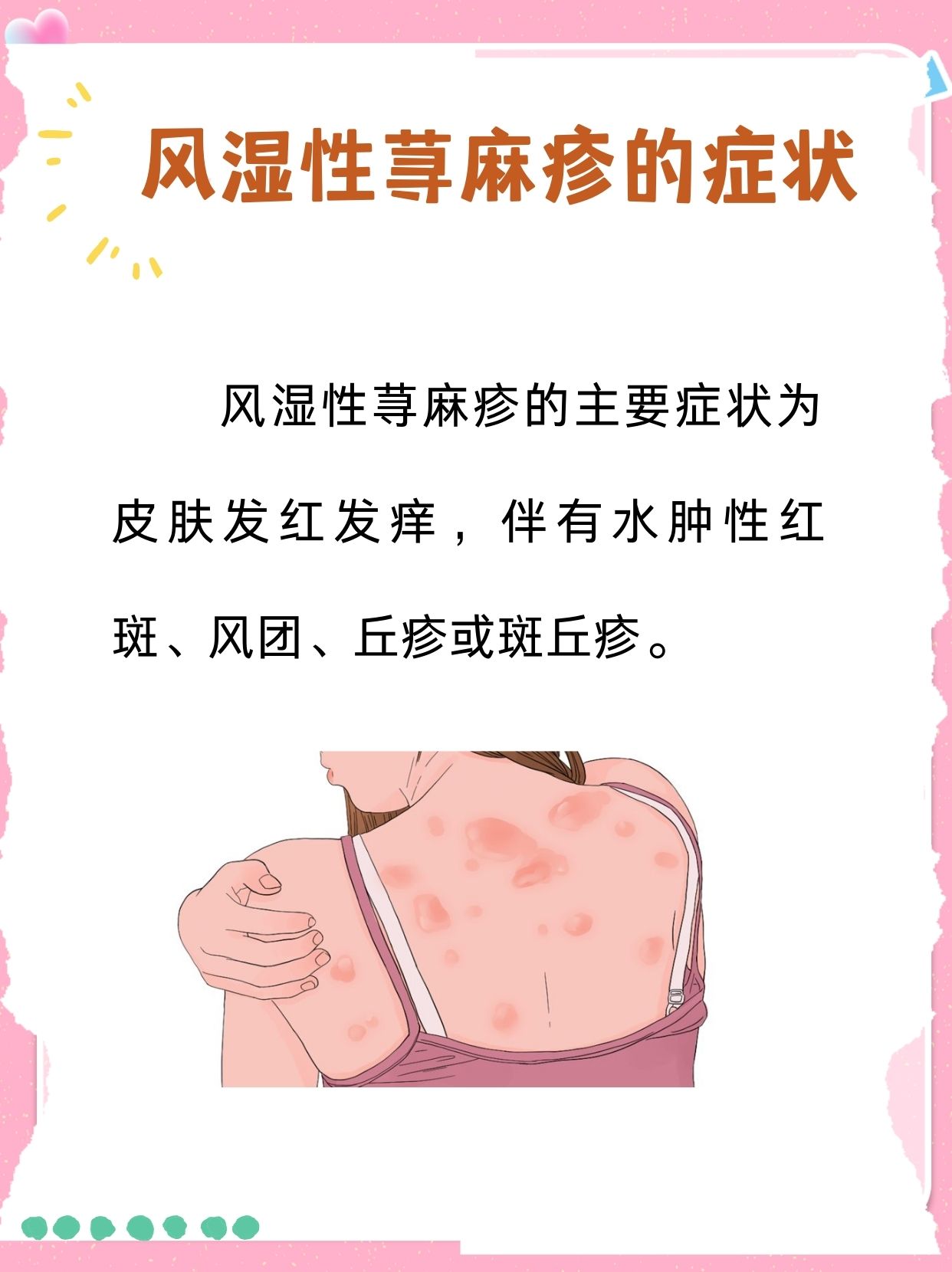 揭秘风湿性荨麻疹,治疗方案在此!