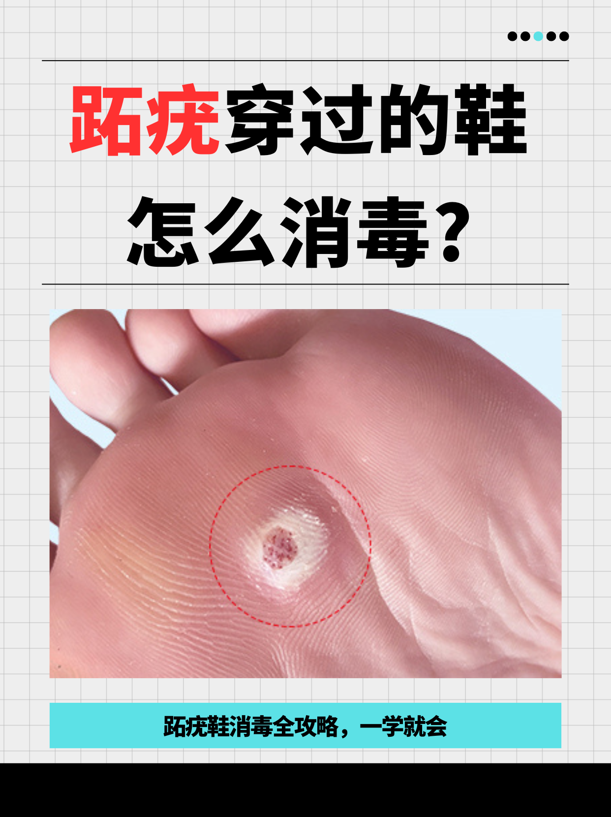 这样处理最干净! 鞋子穿久了长跖疣,换双新鞋太贵,继续穿又担心传染!
