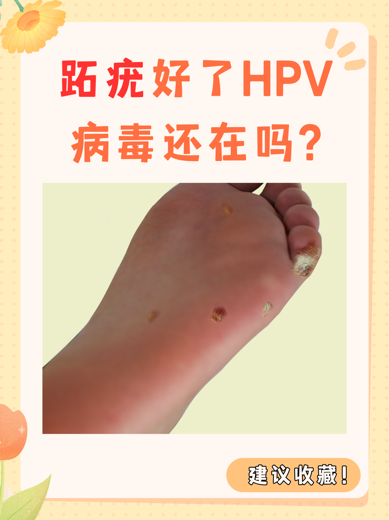 为什么疣体自己消失了