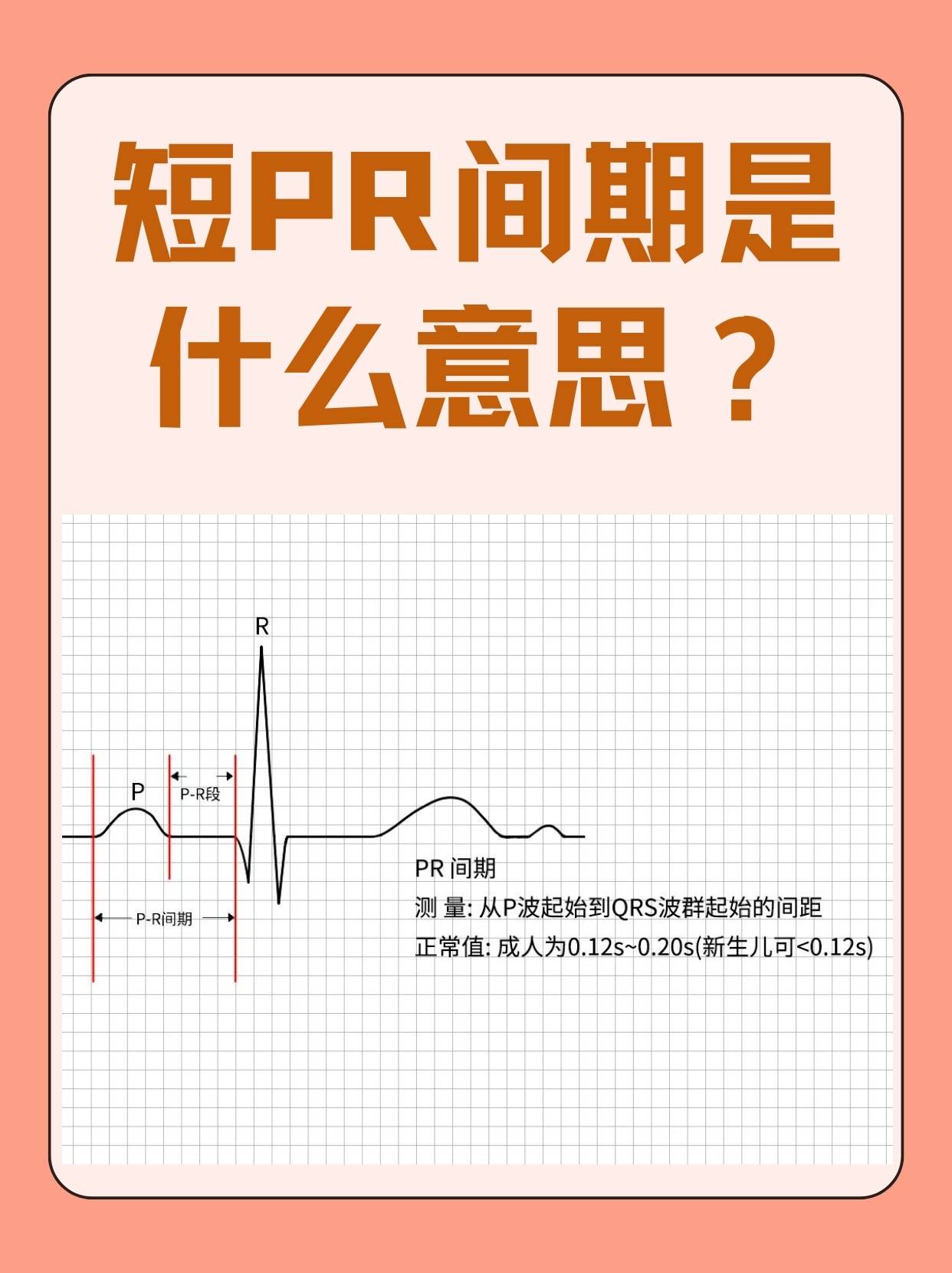 在进行心电图检查后,有些人可能会在报告上看到"短pr间期"这样的
