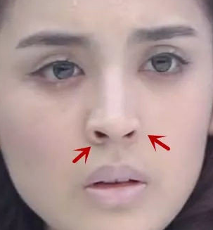 鼻翼后缩,简单来说,就是鼻翼向上移位,导致鼻孔暴露过多,从视觉上看