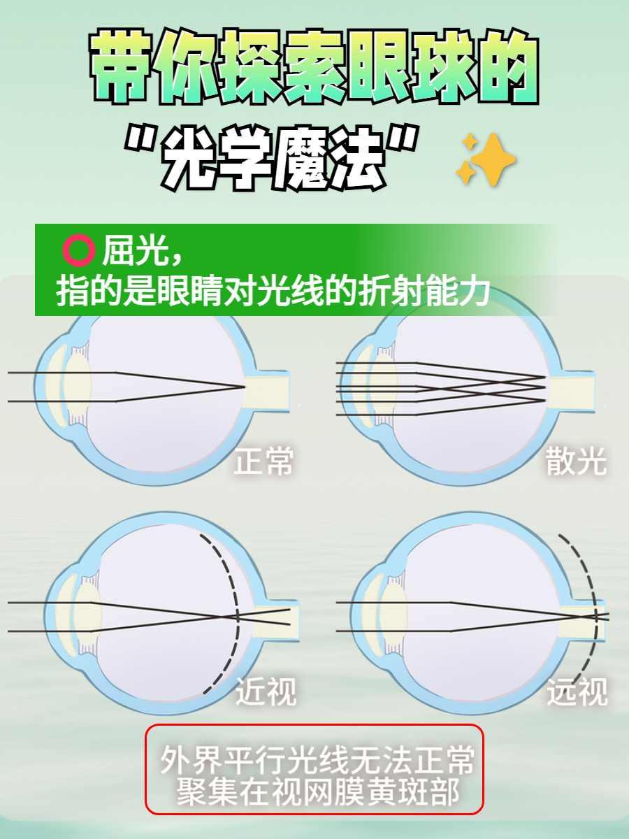 今天,我们就来详细聊聊眼屈光是啥意思,帮助大家更好