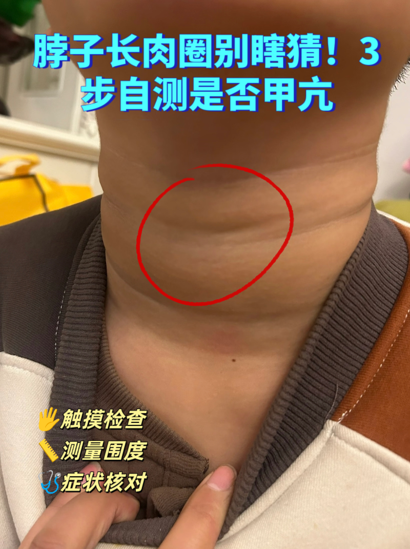 甲亢在医学上通常称为甲状腺功能亢进症,该疾病和普通发胖可大不一样