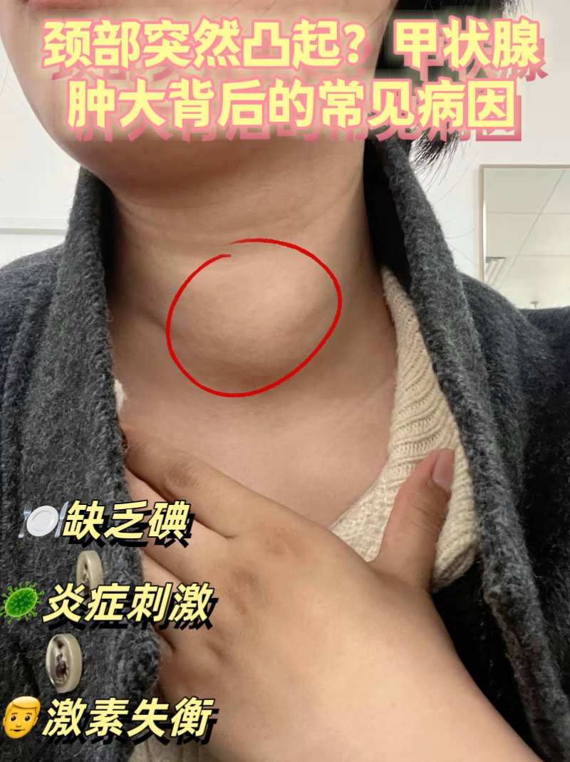 从缺碘到疾病因素,多种原因都可能导致甲状腺肿大