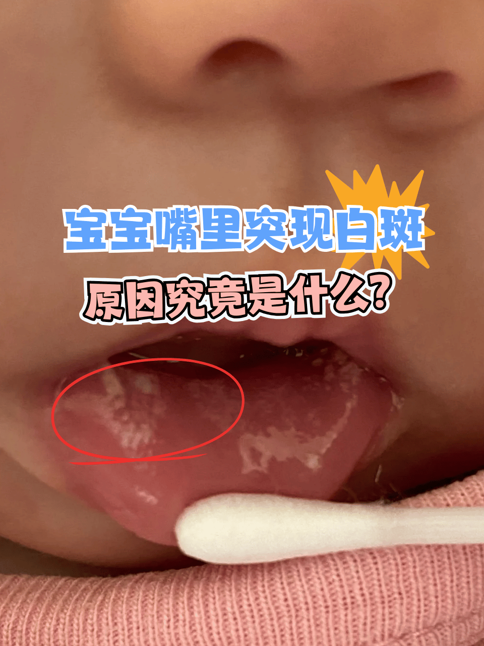 当看到宝宝嘴里冒出白斑,家长们的担忧瞬间涌上心头
