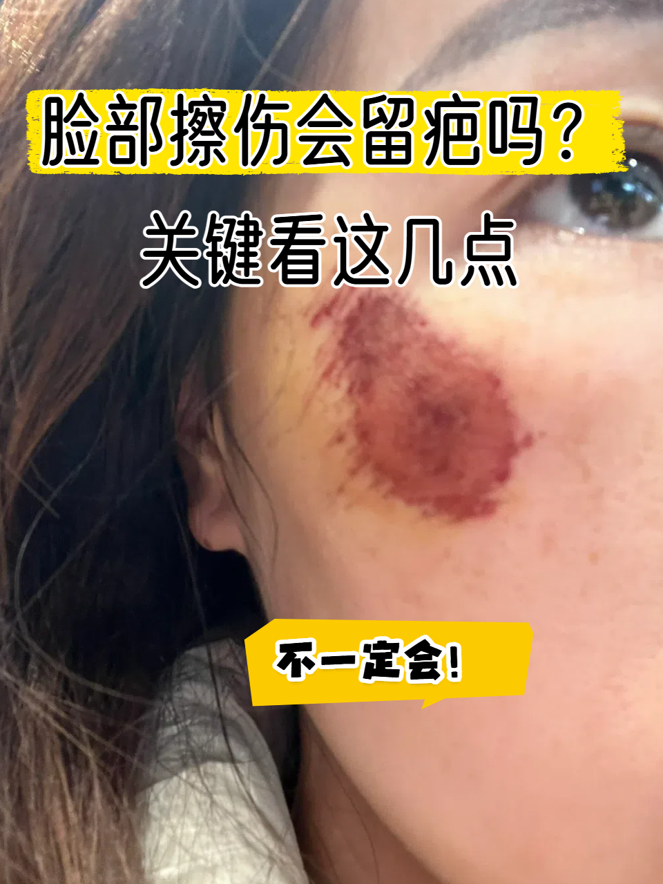 脸上擦伤到底会不会留疤?留疤又该怎么处理?别急,这就为你详细解答!