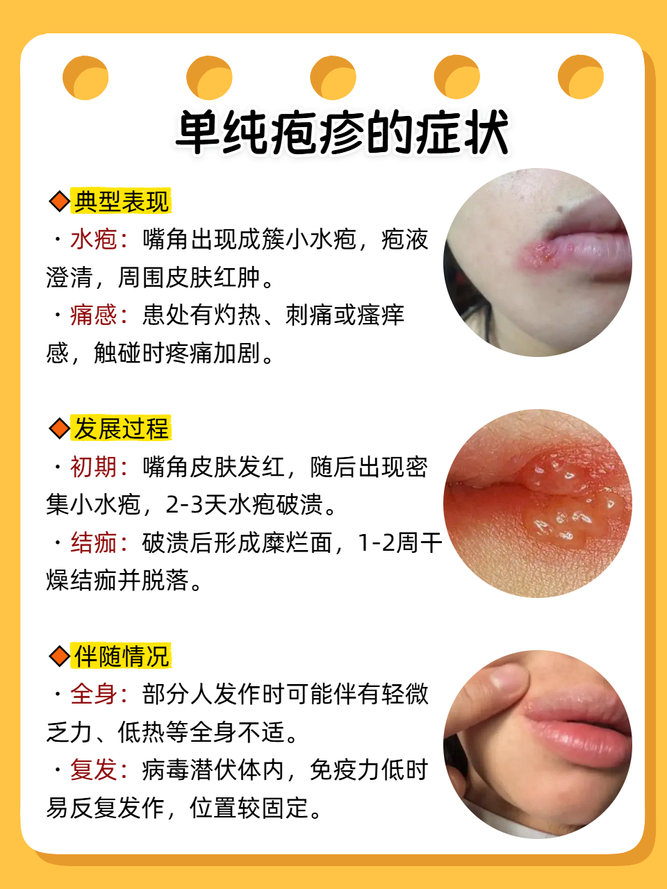 最快水痘的症状和治疗单纯疱疹治疗口周疱疹的最佳治疗方法单纯疱疹图