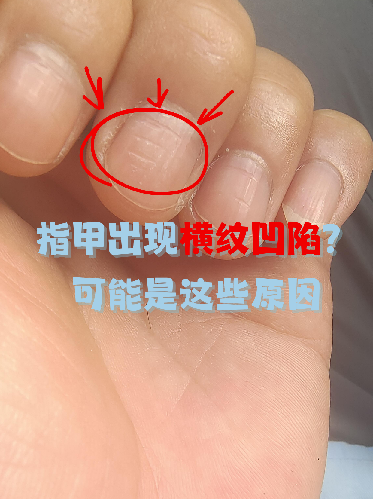 低头突然发现指甲出现横纹凹陷,不少人会心里一紧