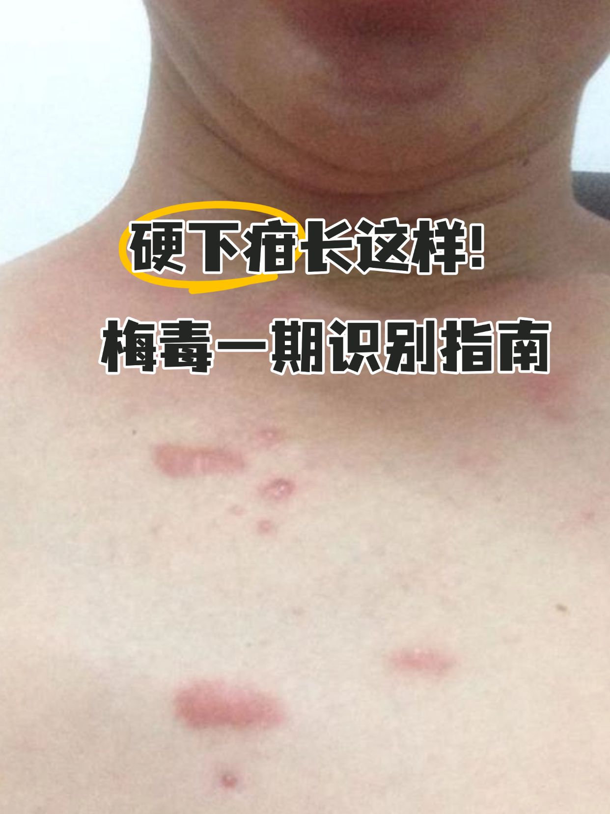 其中,硬下疳作为梅毒早期典型症状,认识它有助于早发现早治疗,一起来