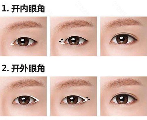 开眼角是开那个部位?