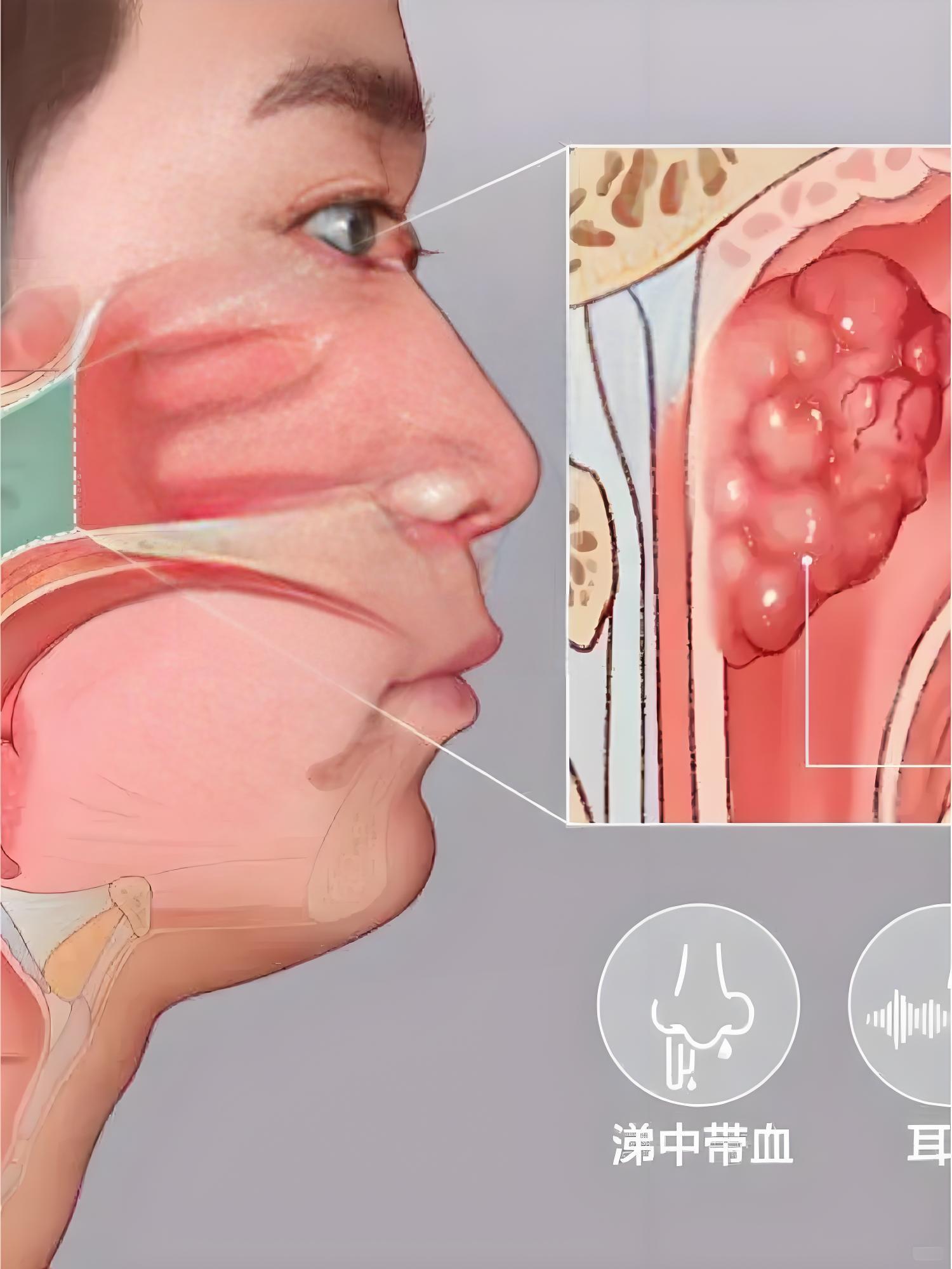鼻咽癌的发生与 eb 病毒感染,遗传因素,环境致癌物及饮食习惯等多